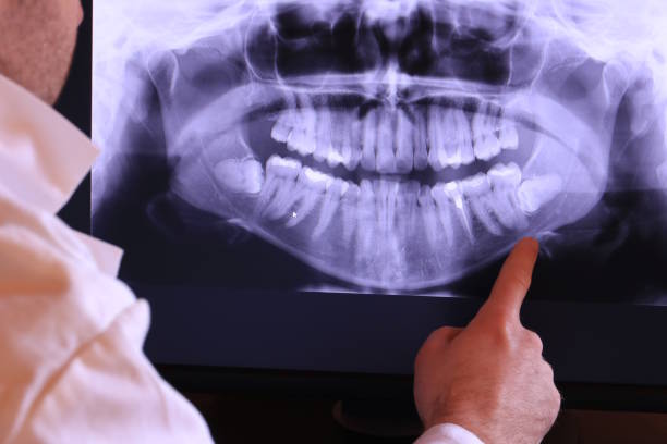 Best Emergency Wisdom Tooth Extraction in Gainesville, VA